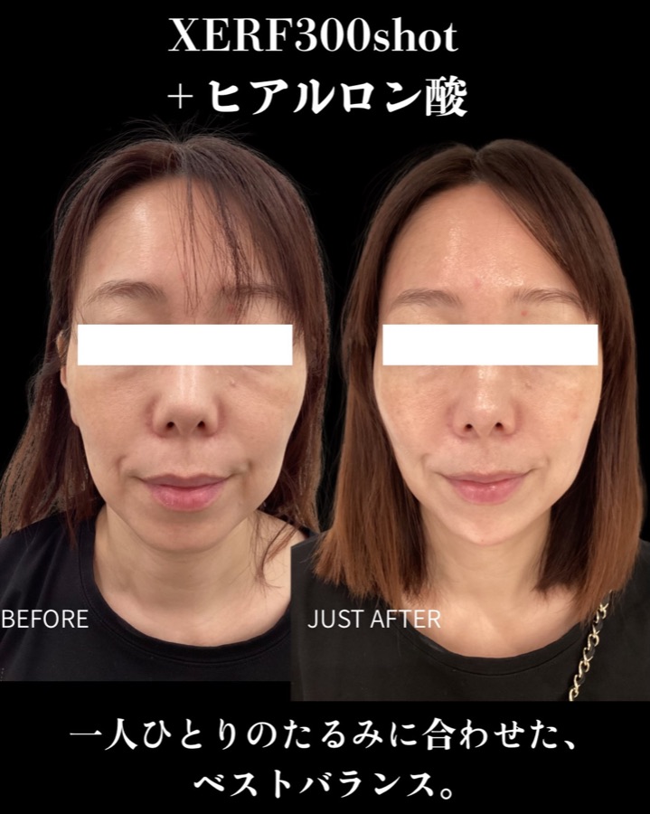 XERF300ショット＋ヒアルロン酸注入の症例写真