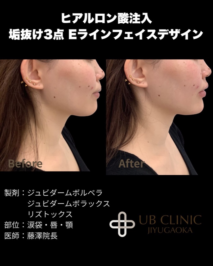 ヒアルロン酸注入(涙袋・唇・顎)の症例写真
