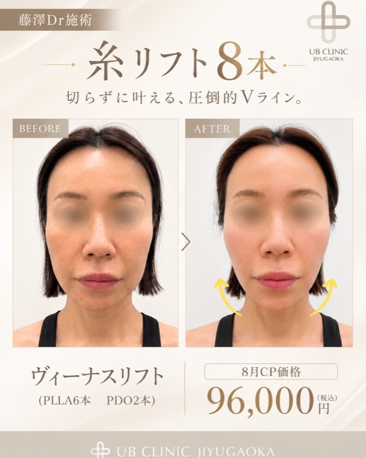 ヴィーナスリフト(糸リフト)8本の症例写真