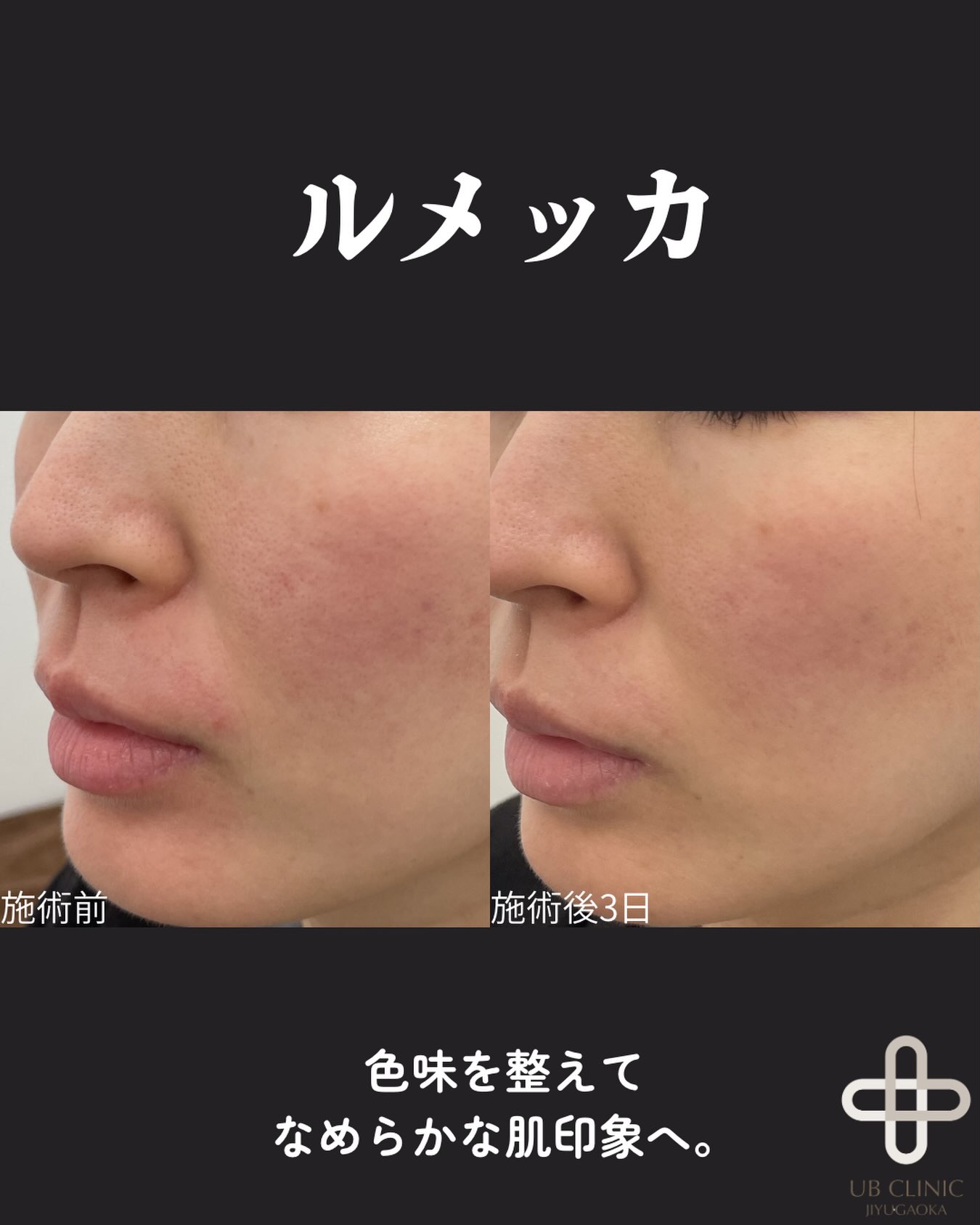 ルメッカの症例写真。施術前 → 施術3日後