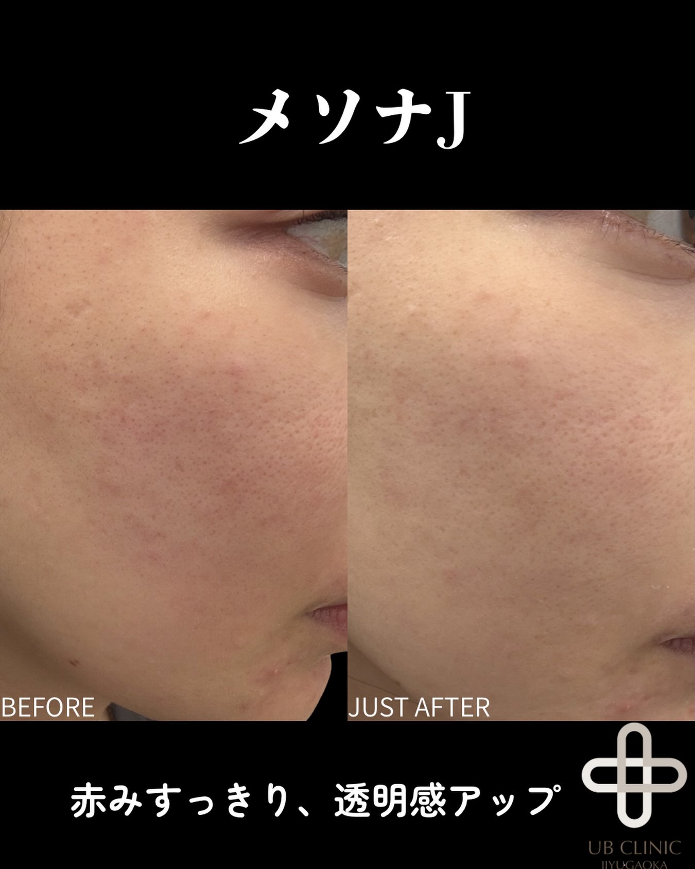 メソナJ 赤みコースの症例写真。施術前 → 施術直後