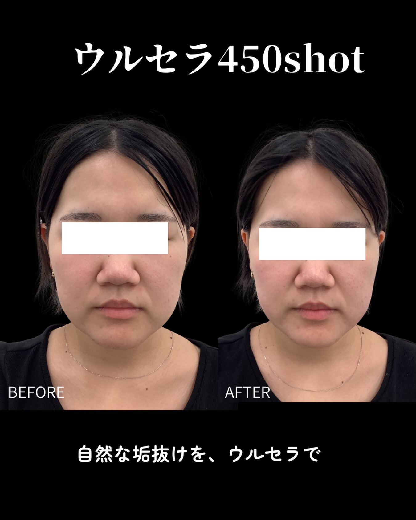ウルセラ450ショットの症例写真。施術前後。施術後写真の撮影時点は原投稿に記載がありません。