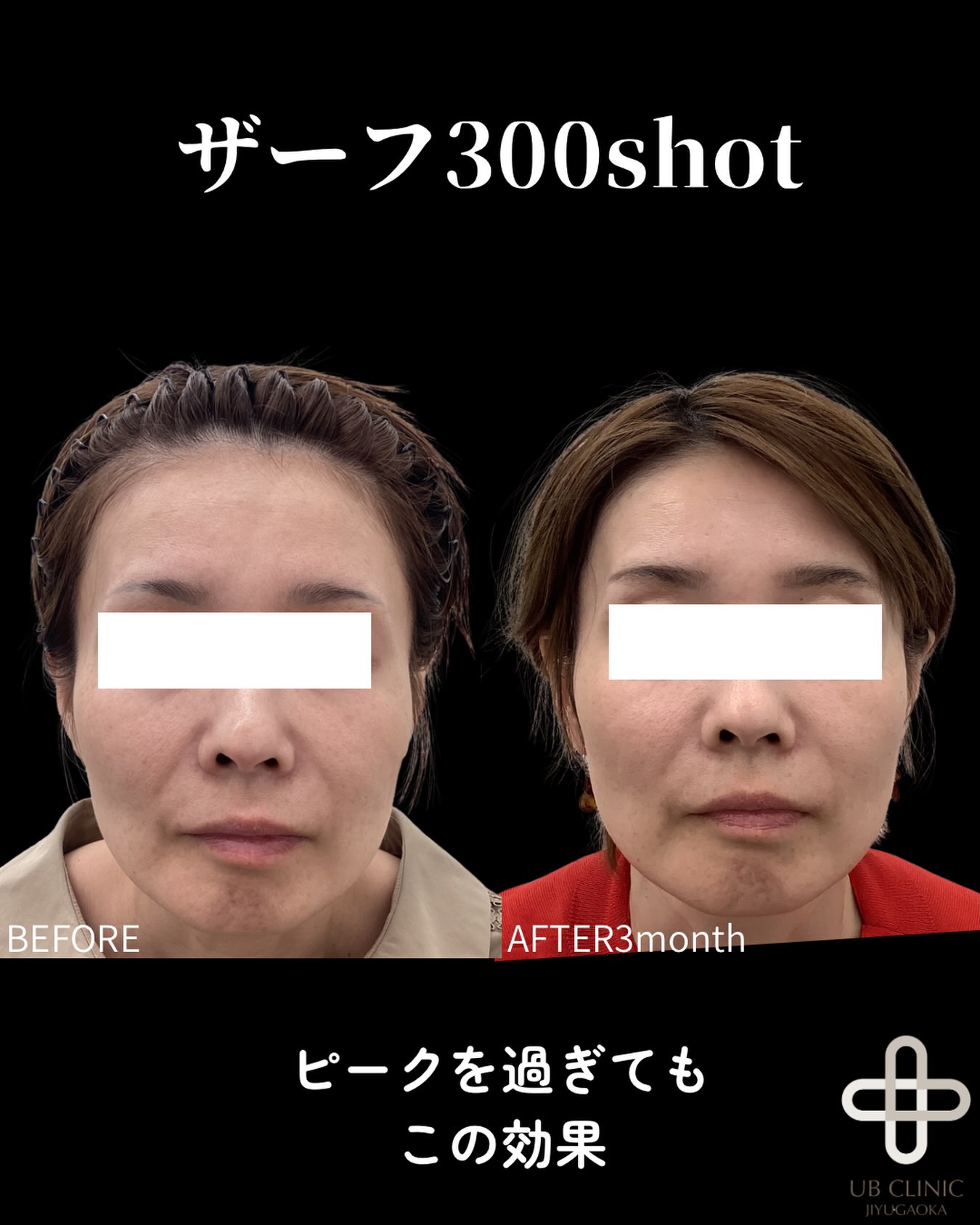 XERF（ザーフ）300ショットの症例写真。施術前 → 施術3か月後